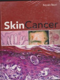Skin Cancer